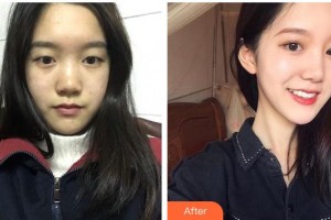 廣元市中心醫(yī)院眼科胡明祥整形價格表附眼部綜合案例展示