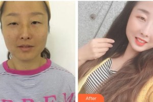 廣元市中心醫(yī)院眼科谷成勝整形價格表附內(nèi)切祛眼袋案例展示