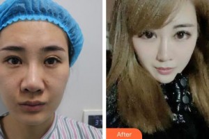 廣元市中心醫(yī)院眼科肖賢柳整形價格表附眼部綜合案例展示