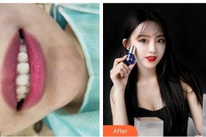 廣元口腔醫(yī)院董世林整形價格表附牙齒隱形矯正案例展示