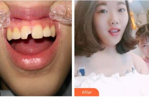 廣元口腔醫(yī)院陳遠禮整形價格表附美白貼片案例展示