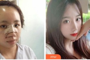 遂寧市康博醫(yī)學(xué)美容診所常太平整形價格表附鼻部綜合案例展示