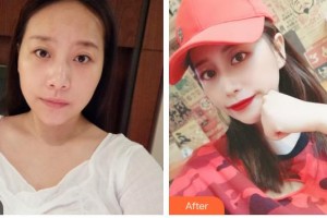 遂寧市康博醫(yī)學(xué)美容診所李紅梅整形價格表附肋軟骨隆鼻案例展示