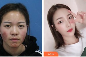 遂寧雙華醫(yī)學(xué)整形美容門診部常雙華整形價格表附膨體隆鼻案例展示