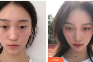 遂寧伊莎貝拉醫(yī)學(xué)美容門診部羅華整形價格表附眼部綜合案例展示