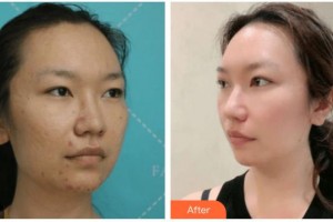 遂寧愛瑞陽光眼科醫(yī)院整形價格表附切開雙眼皮案例展示