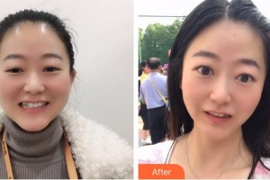 遂寧嘉慧口腔門診部整形價格表附牙齒隱形矯正案例展示