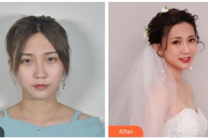 內江市中醫(yī)醫(yī)院百合醫(yī)學美容中心薛明整形價格表附眼部綜合案例展示