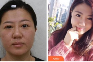 內江市中醫(yī)醫(yī)院百合醫(yī)學美容中心張艷鋒整形價格表附埋線雙眼皮案例展示