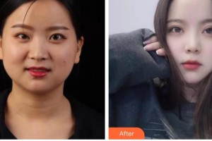 內江市中醫(yī)醫(yī)院百合醫(yī)學美容中心蘭潔整形價格表附眼部綜合案例展示