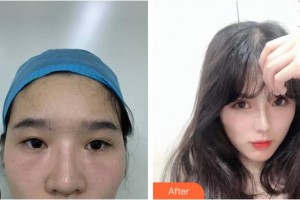 內江百齡京菊醫(yī)療美容門診部龍卓宏整形價格表附眼部修復案例展示