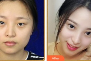 內江百齡京菊醫(yī)療美容門診部徐勇整形價格表附眼部綜合案例展示