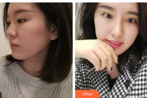 內江百齡京菊醫(yī)療美容門診部劉培整形價格表附眼部綜合案例展示