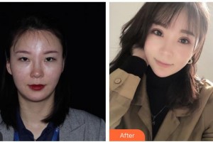 內江百齡京菊醫(yī)療美容門診部李果整形價格表附眼部綜合案例展示