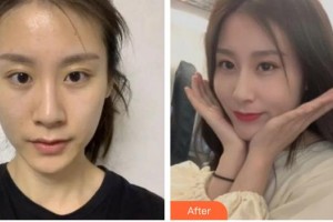 內江百齡京菊醫(yī)療美容門診部文斌整形價格表附切開雙眼皮案例展示