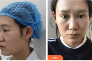 內江瑞美醫(yī)療美容門診部楊娟整形價格表附眼部綜合案例展示