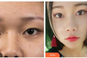 內江瑞美醫(yī)療美容門診部羅冬鈴整形價格表附切開雙眼皮案例展示