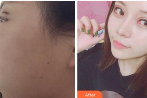 內江瑞美醫(yī)療美容門診部金承俊整形價格表附眼部綜合案例展示