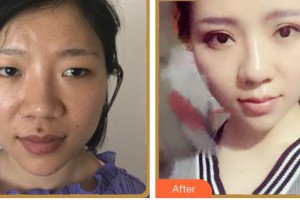 內江洋子醫(yī)療美容診所羊一華整形價格表附眼部綜合案例展示