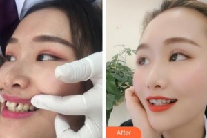 內江華美口腔醫(yī)院代季佩整形價格表附隱形托槽矯正案例展示