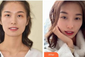 內江華美口腔醫(yī)院剛整形價格表附牙齒隱形矯正案例展示