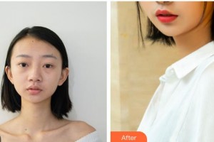 樂山金手指醫(yī)學美容診所岑曉勇整形價格表附鼻部綜合案例展示