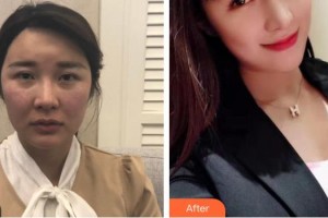 樂山金手指醫(yī)學美容診所方名整形價格表附肋軟骨隆鼻案例展示