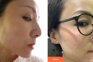 樂山金手指醫(yī)學美容診所羅秀平整形價格表附埋線提升案例展示