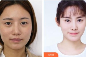 樂山市人民醫(yī)院燒傷整形外科賴運泰整形價格表附眼部綜合案例展示