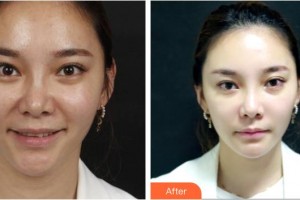 樂山市人民醫(yī)院燒傷整形外科季明軍整形價格表附埋線提升案例展示