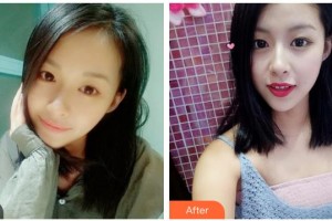 樂山王玉琨皮膚病?？漆t(yī)院張麗整形價格表附眼部綜合案例展示