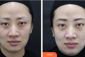 樂山王玉琨皮膚病?？漆t(yī)院王玉琨整形價格表附激光去眼袋案例展示