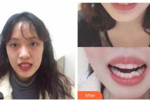 樂山口腔醫(yī)院龐洪整形價(jià)格表附牙齒隱形矯正案例展示