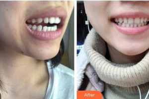 樂山口腔醫(yī)院張麗梅整形價(jià)格表附牙齒隱形矯正案例展示