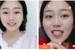 樂山口腔醫(yī)院汪培林整形價(jià)格表附牙齒隱形矯正案例展示