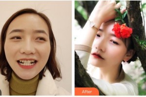 樂山口腔醫(yī)院何肖倩整形價(jià)格表附牙齒隱形矯正案例展示