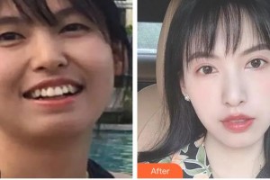 樂山口腔醫(yī)院魏寧整形價(jià)格表附金屬托槽矯正案例展示