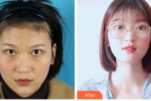 樂山愛爾眼科醫(yī)院張繼萍整形價(jià)格表附內(nèi)切祛眼袋案例展示