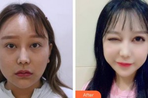 樂山愛爾眼科醫(yī)院帥彤整形價(jià)格表附眼部綜合案例展示