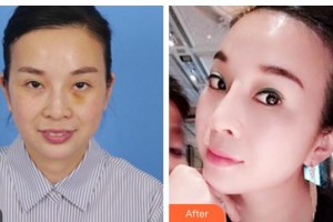 南充中心醫(yī)院整形美容外科劉鴻雁住院醫(yī)師整形價(jià)格表附埋線提升案例展示