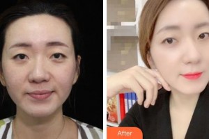 南充阿藍(lán)醫(yī)療美容門診部朱園杰整形價(jià)格表附熱拉提案例展示