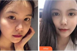 南充阿藍醫(yī)療美容門診部蘭秀整形價格表附熱瑪吉案例展示