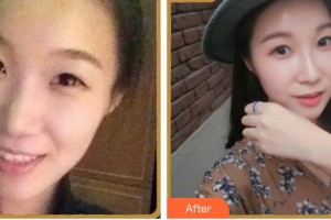 南充韓美整形美容門診部陳斌整形價(jià)格表附熱瑪吉案例展示