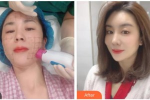 南充新韻悅美醫(yī)療美容門診部付崇華整形價(jià)格表附熱瑪吉案例展示