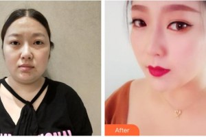 南充新韻悅美醫(yī)療美容門診部陳秀蕓整形價(jià)格表附熱瑪吉案例展示