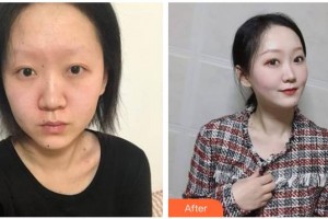 南充五星美容整形門診部劉隆澤整形價(jià)格表附埋線提升案列展示