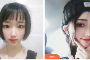 南充五星美容整形門診部唐雨珍整形價(jià)格表附切開雙眼皮案例展示