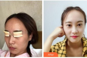 南充華美名媛整形美容醫(yī)院彭旦生整形價格表附切開雙眼皮案例展示