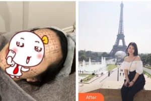 南充嬌美傾城醫(yī)學(xué)美容門診部余劍雄整形價(jià)格表附熱瑪吉案例展示