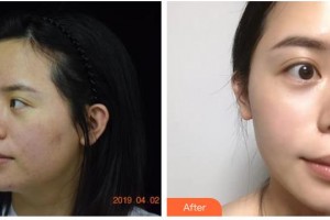 南充醫(yī)美整形外科診所李莎整形價(jià)格表附射頻緊膚案例展示